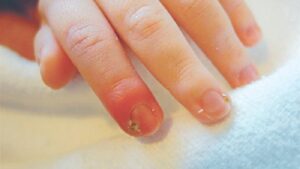 Bệnh chín mé là gì? Cách chữa chín mé dân gian hiệu quả và an toàn